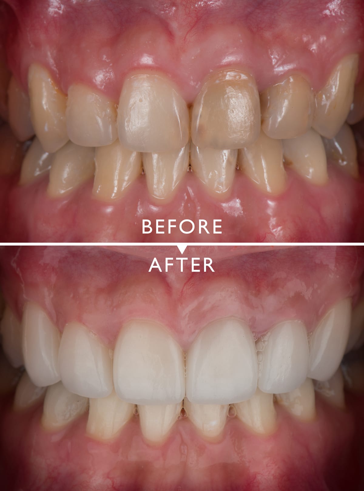What Are The Differences Between Composite Resin Bonding & Veneers?