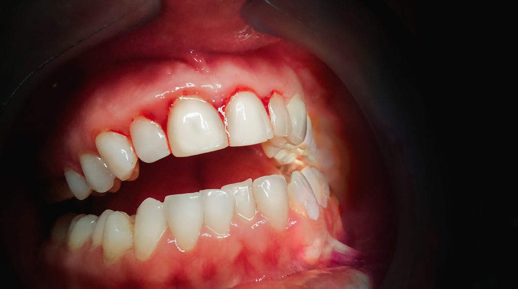 gum-disease-treatment-dentist-lisbon-maine