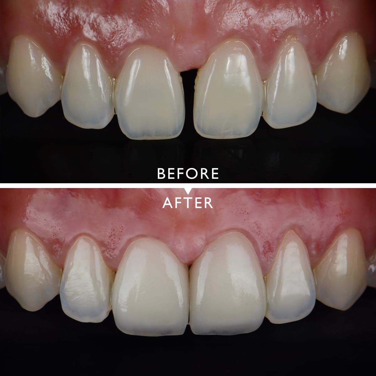 2pressed Ceramic Veneers Treatment For Gap Closing At Central Incisors Before And After Lisbon Maine Dentist  