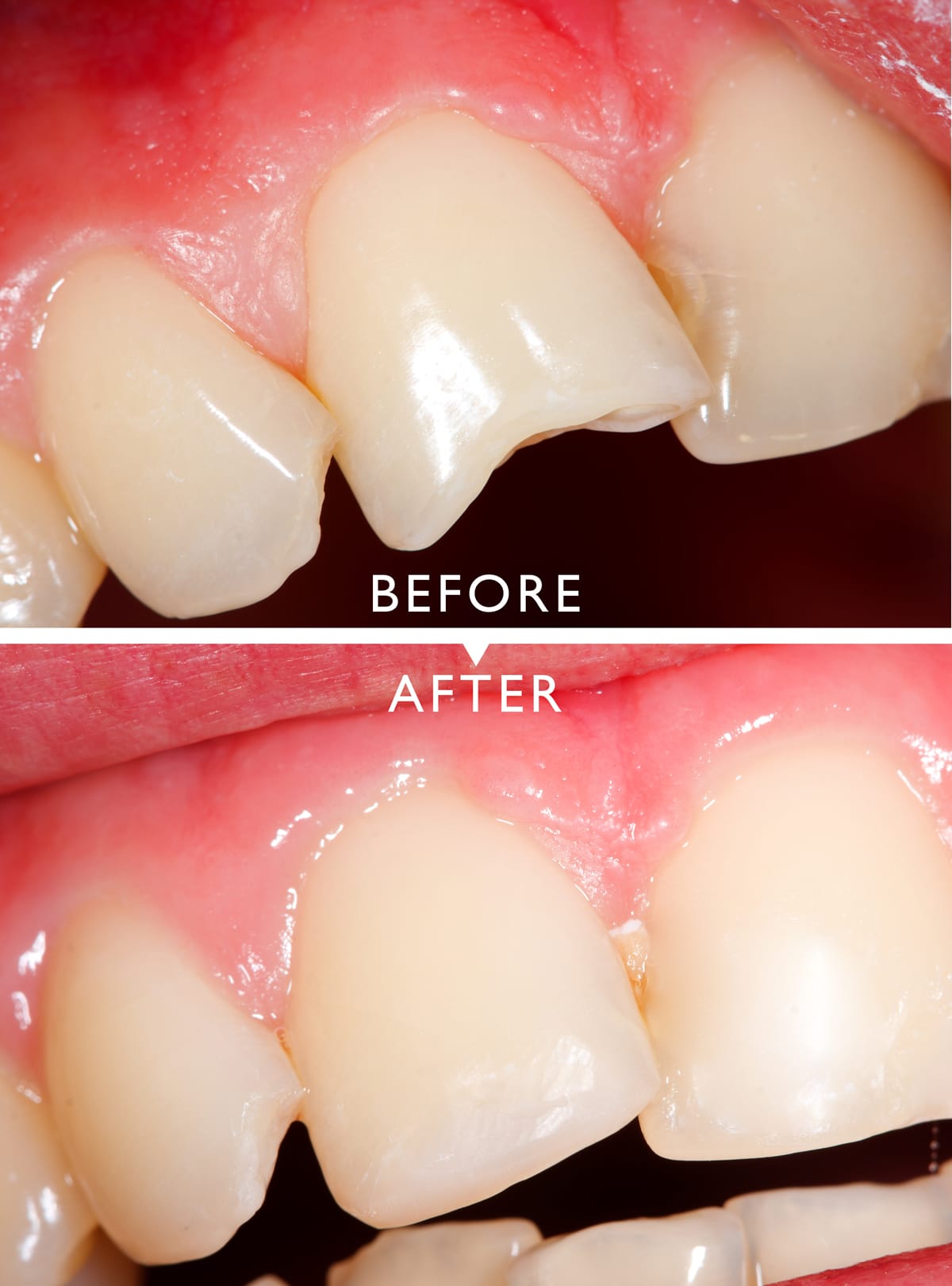 Before & After Photos, Cracked Tooth Repair Gallery